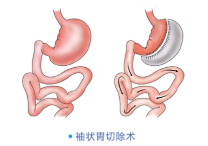 切胃減肥手術(shù)